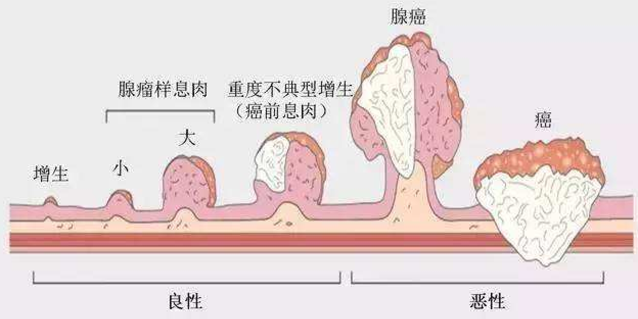 肠息肉与肠癌有哪些不同如何阻止癌变肛肠外科专家隋金珂