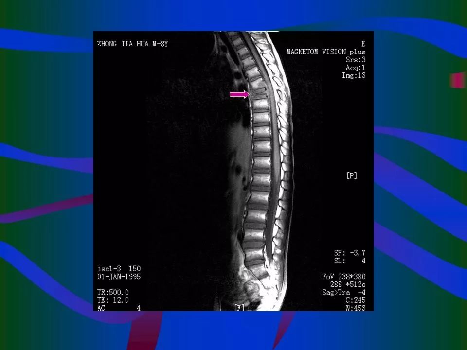脊柱结核的ct及mri诊断影像天地