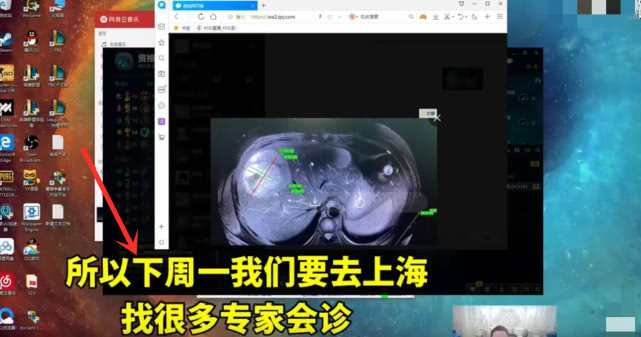 pdd直播辟谣并没有身患12颗肿瘤自己身体好得很