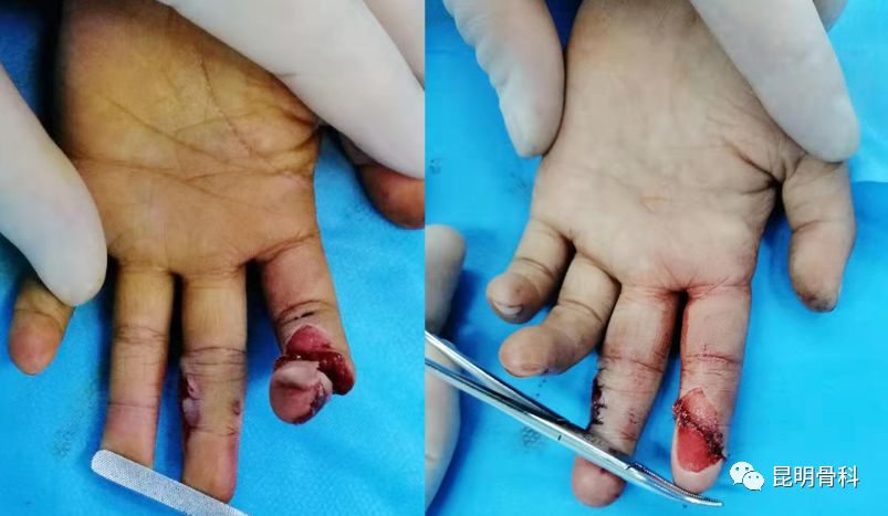 为救2岁妹妹7岁男孩被石块砸断手指