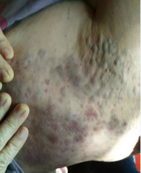 身体各部位拍痧方法五腹部