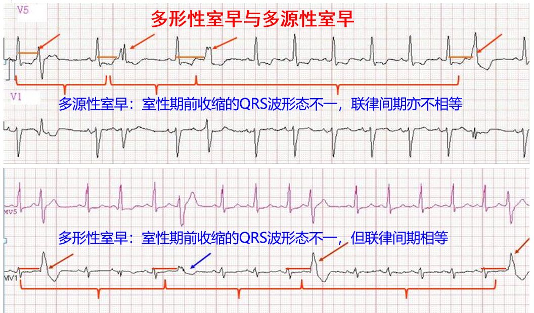 当麻醉遇上室性早搏