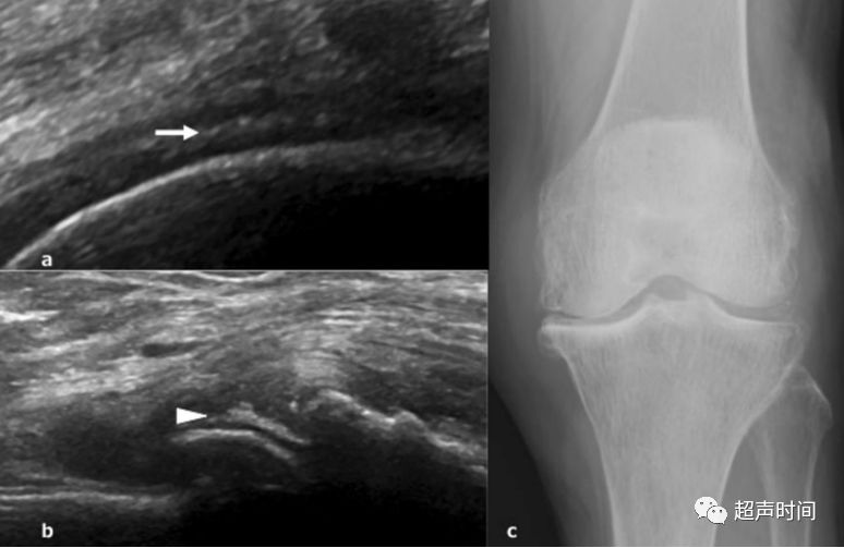 实用干货丨骨关节炎和超声