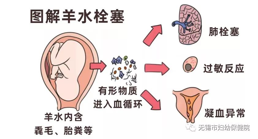 【妇幼科普】不能不知道的"产科死神—羊水栓塞