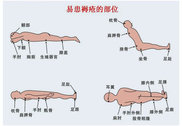 伤口床有活性,呈粉色或红色,湿润,也可表现为完整的或破损的浆液性