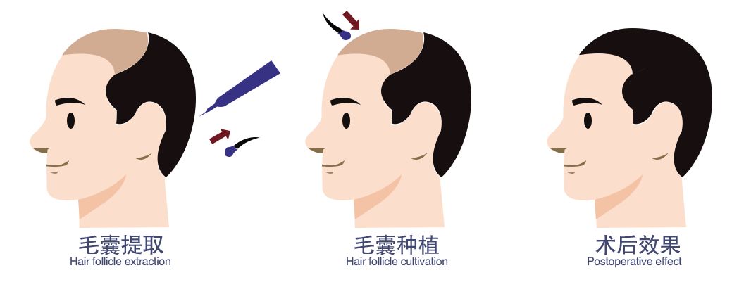 年纪轻轻就脱发秃顶怎么办全省招募毛发缺失者可申请免费植发脱发秃顶