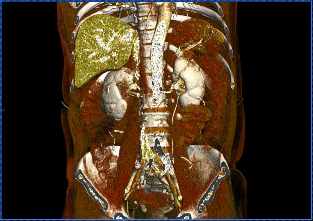 我所引进世界最先进ct应用新技术国内首家应用图像极度逼真