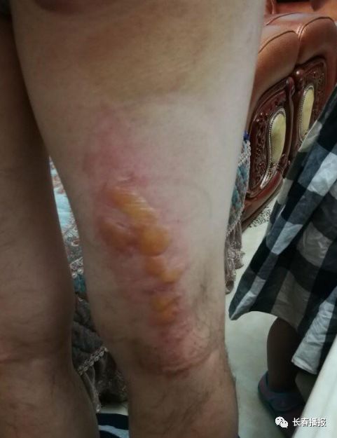 按摩,针灸后艾灸被烫伤,艾灸过程中按摩师把艾灸盒放在老人身上,又去