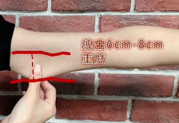 6cm,属于中度能拽出2cm-4cm,属于轻度能拽出1cm-2cm,属于正常单手臂