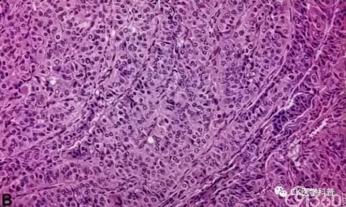 指南共识l2019甲状旁腺癌诊治的专家共识中03甲状旁腺癌的病理注解版
