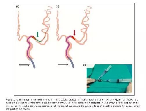 手工抽吸血栓配合支架取栓示意图