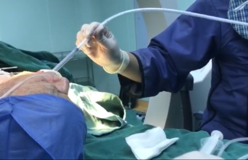 七旬老人吃东西难以下咽,专家食管内"撑伞"帮助进食_治疗