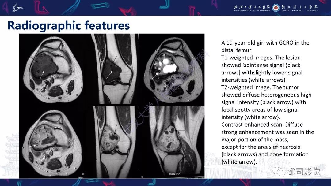 富於鉅細胞性骨肉瘤影像診斷
