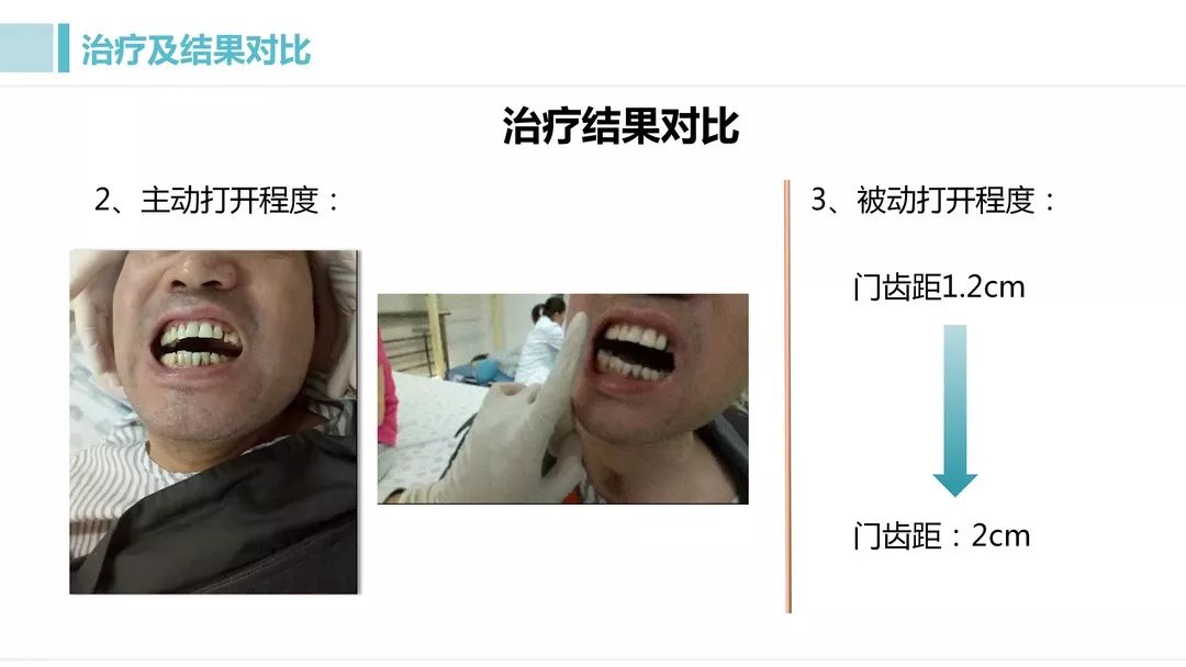 【病例报道】口腔准备期中的张口困难问题分析