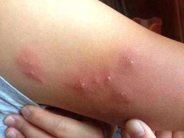 蒙城这些地方的房子不要租床虫泛滥成灾dt的床虫数量让人头皮发麻