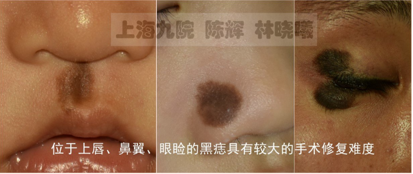 黑色素痣——"痣"关重要的诊疗常识——上海九院陈辉