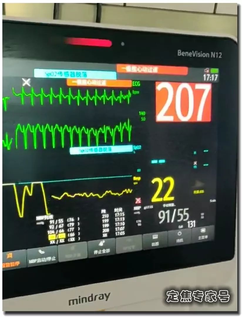 心率小于60次/分就被称为心动过缓.