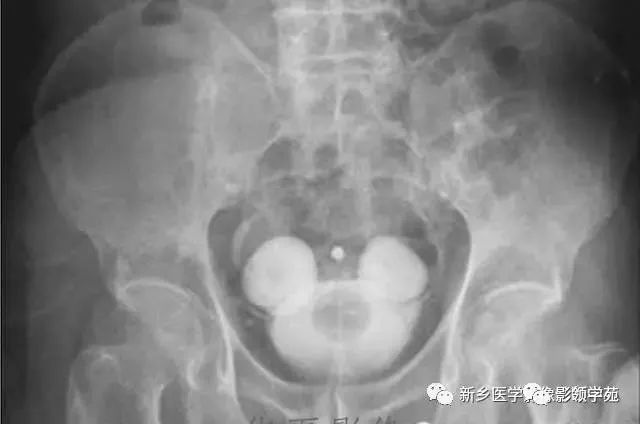 18种膀胱病变影像表现你见过几种