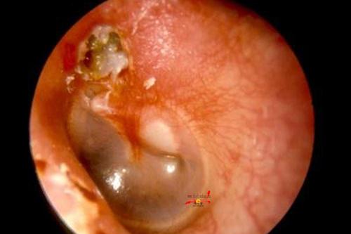 也比较直,一些鼻分泌物等一些容易经过咽鼓管然后流入或者呛入中耳,从