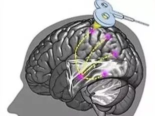失眠,或者有睡眠障碍的人,不妨试试重复经颅磁刺激(rtms).