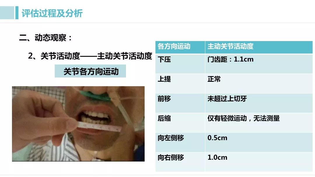 张口受限一度二度三度图片