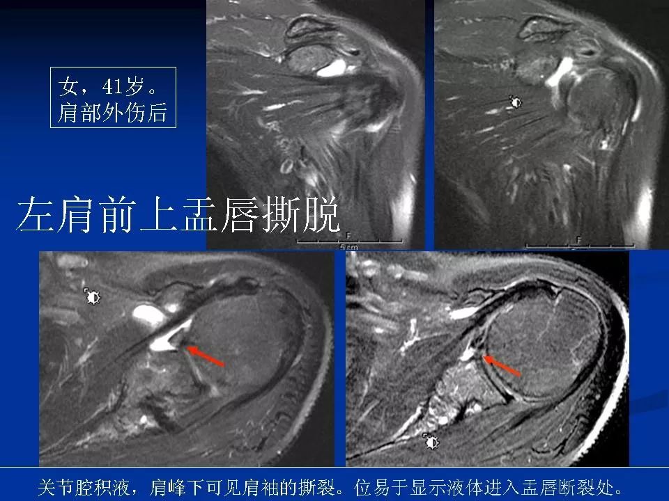 肩关节盂唇损伤的mri诊断影像天地