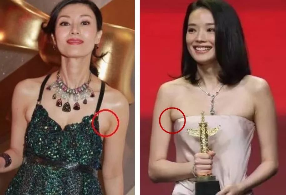 像明星露出的副乳,大多是因为服装或内衣选择不当,把胸部乳肉挤压溢出