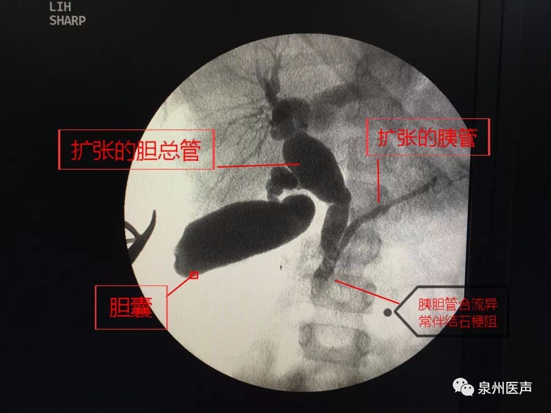 双镜合璧,探囊取石,这家医院成功开展泉州市首例双镜联合下胆总管囊肿