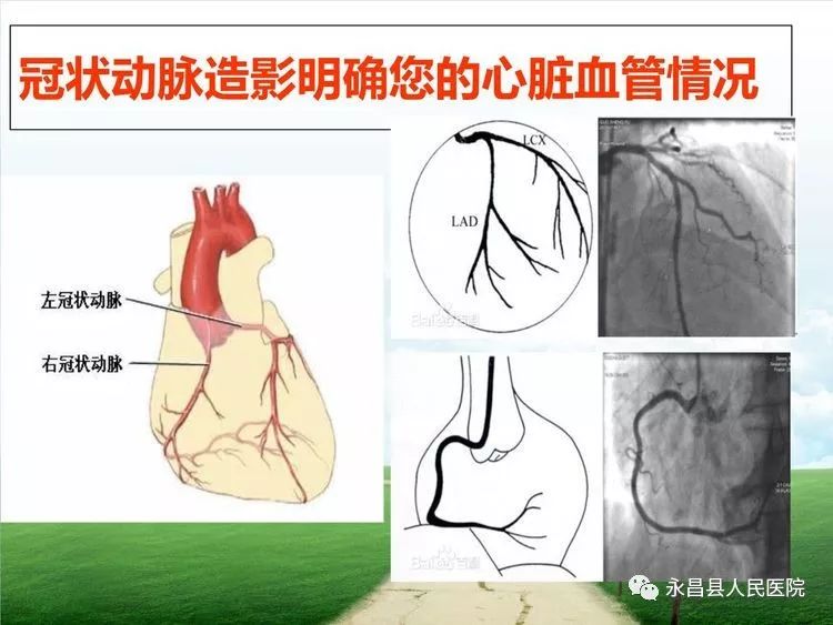 心脏冠脉造影图解图片