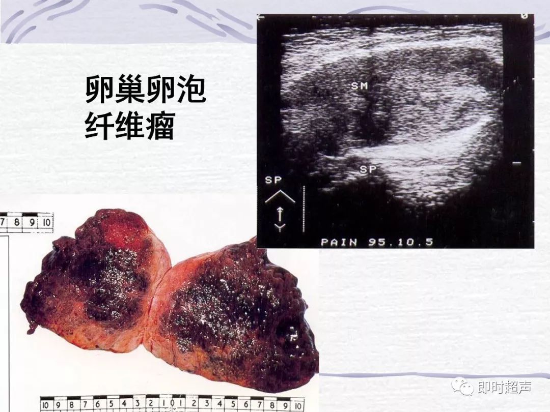 卵巢纤维瘤超声图片图片