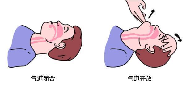 3,具体操作方法: ① "a"是打开气道,使伤病员平躺在硬板或地面上