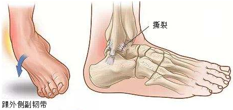 踝关节外侧副韧带损伤的治疗足踝外科专家宋斌科普系列