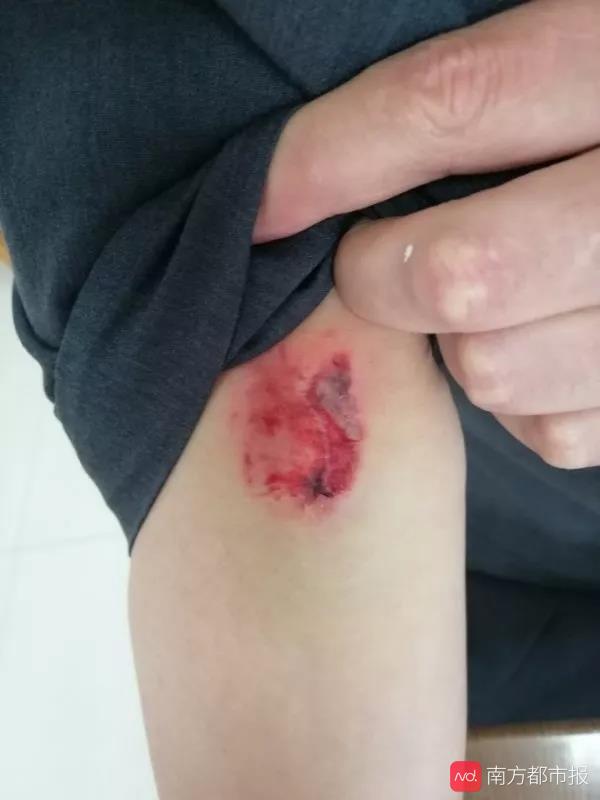 江苏南京一法院执行法官在案件执行过程中被hiv病毒携带者咬伤出血一