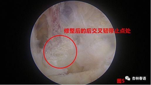 東院之窗我院東院區骨傷科成功完成一例後交叉韌帶聯合內側副韌帶斷裂