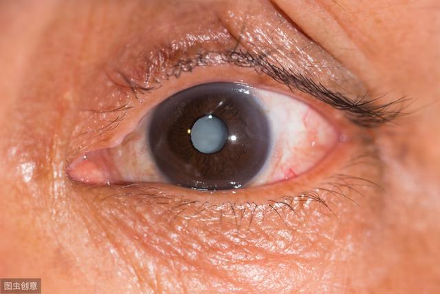 白内障——手术是治疗的唯一方式