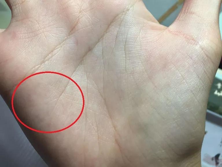 结肠区位于胃区域旁边,此处若是出现红白相间小点,就是中医讲的泄泻