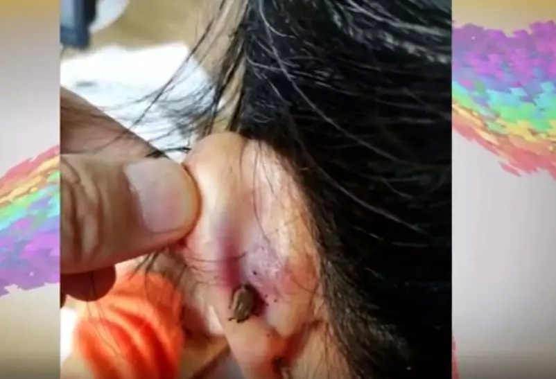 耳朵里虫子竟然安家产卵