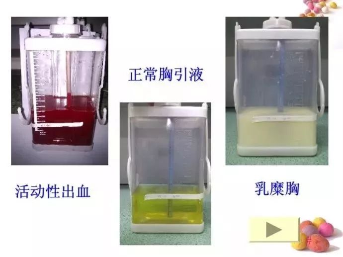 一文梳理胸腔闭式引流的护理要点