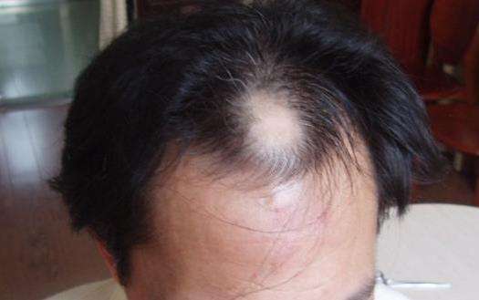 男性脱发可以治疗好吗?