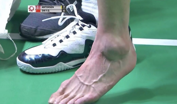 新一哥最新伤情:自曝骨头无碍韧带撕裂 大概率将无缘世锦赛_石宇奇