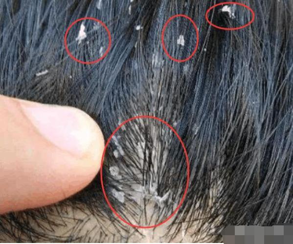 还会交叉感染其分泌具有腐蚀阻塞作用,头上螨虫一旦爆发头皮屑会非常