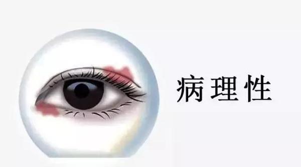 眼皮跳是病,得治_眼瞼