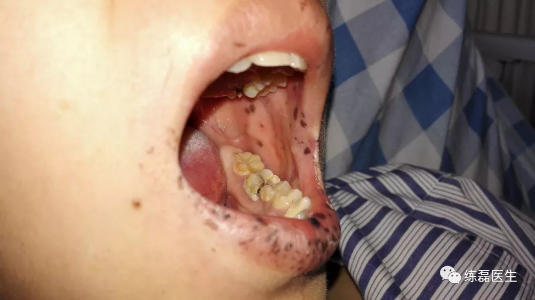 peutz-jeghers综合征(一)