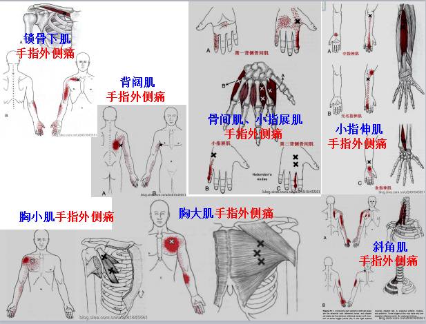 全身激痛点手册图片