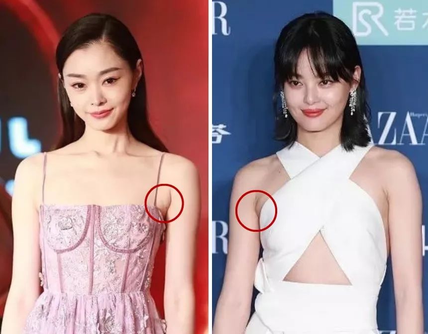 像明星露出的副乳,大多是因为服装或内衣选择不当,把胸部乳肉挤压溢出