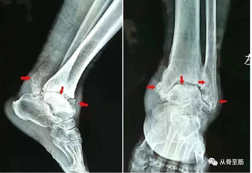 没有明显外伤也会得创伤性关节炎吗