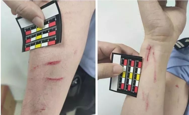 民警急忙抽手,女子用长指甲在民警手臂上留下多道抓痕.