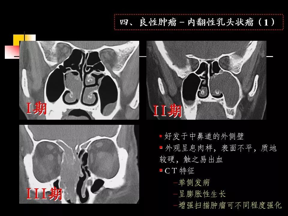 鼻腔鼻竇的ct解剖及該區域常見疾病的影像學診斷影像天地