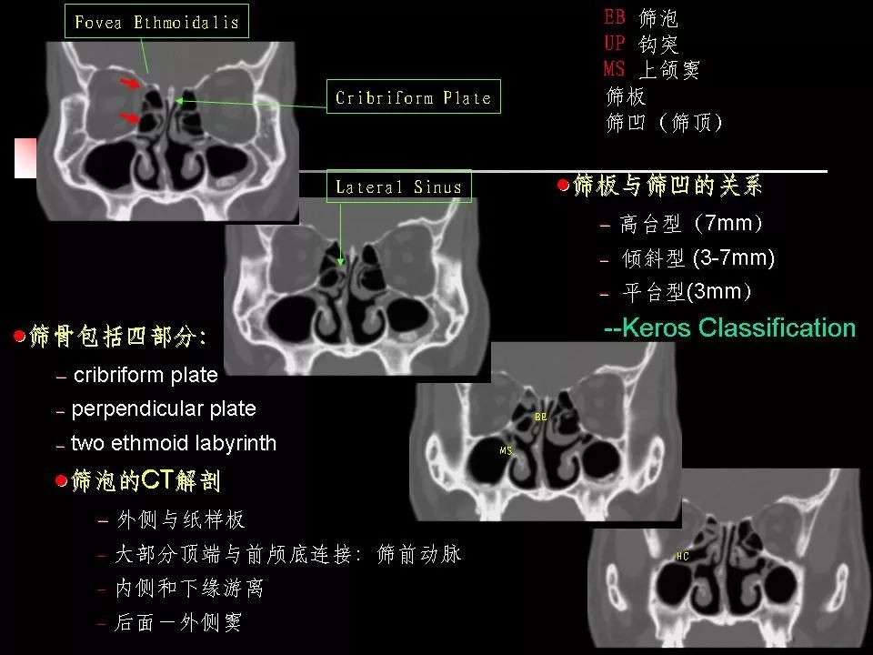 鼻腔,鼻窦的ct解剖及该区域常见疾病的影像学诊断 