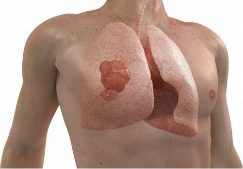 记住5个肺癌必定出现的前兆,准确识别肺癌